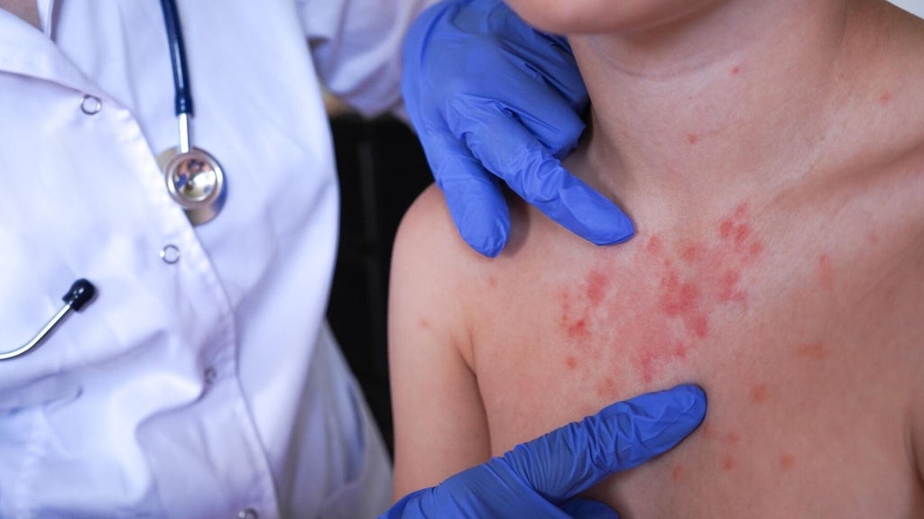 Minnesota's 80 measles cases this year are the most since 1990, health officials say — Minneapolis Health news